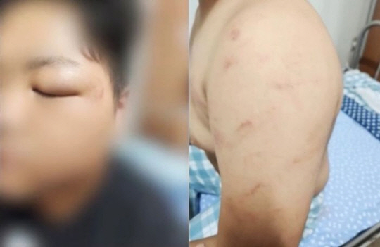 또래 여중생들에게 집단 폭행당한 장애 남학생의 모습. [MBC 보도화면 캡처]